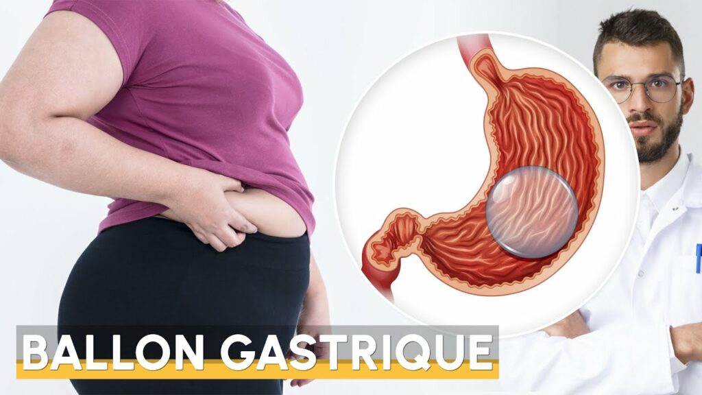 Comment se préparer avant un ballon gastrique — free download